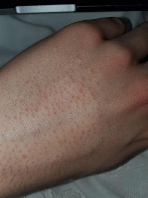 Red Dots On Back Of Hands Raccutane