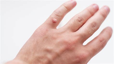Wart Treatment And Removal Toronto Dermatology Centre