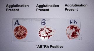 It's best when a donor and. Blood Group test कैसे करते है - ABO Slide Method ~ Lab ...
