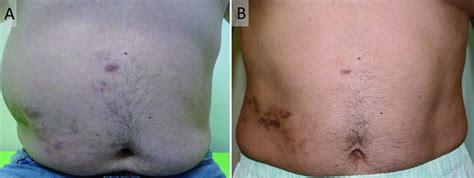 Postherpetic Abdominal Pseudohernia The Bmj
