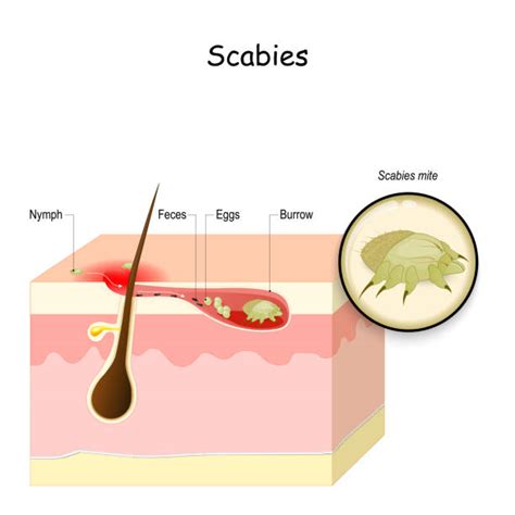 Scabies Rash Stock Photos Pictures And Royalty Free Images Istock