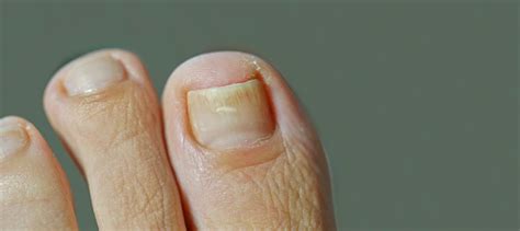 Foot With Nail Psoriasis Onychomycosis Woman With An Ingrown Toenail