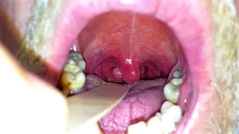 Mass In The Uvula Youtube