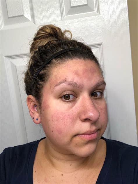 36w1d Pregnant And Rash On Face Glow Community