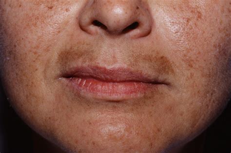 Your Guide To Melasma How To Treat Tricky Dark Spots The Pretty Pimple