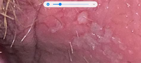 What std's cause warts or bumps, and where on they body can they grow, help(std wart or ingrown hair pimple or herpes? what is this 😳 | Genital Herpes Simplex | Forums | Patient
