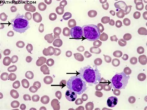 Histopathology Images Of Chronic Myelomonocytic Leukemia
