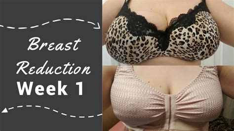 Breast Reduction Week Post Op Chat Youtube Hot Sex Picture