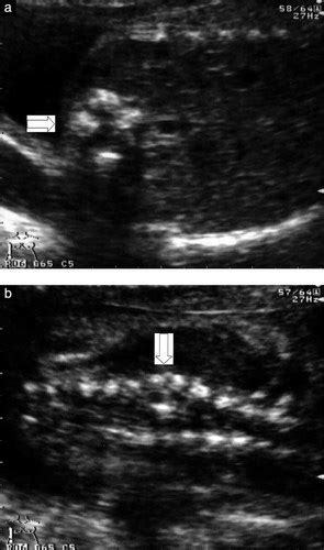 Prenatal Diagnosis Of Diastematomyelia Presentation Of Eight Cases And