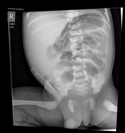 Colonic Atresia Radiology Case Radiopaedia Org