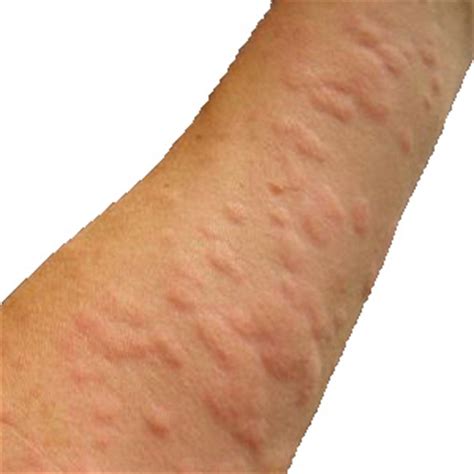 Small bumps on skin that itch. 5 Reasons Why You Have Small Red Itchy Bumps | New Health ...
