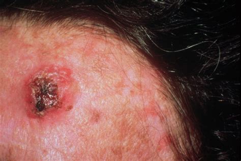 Skin Cancer Types With Pictures