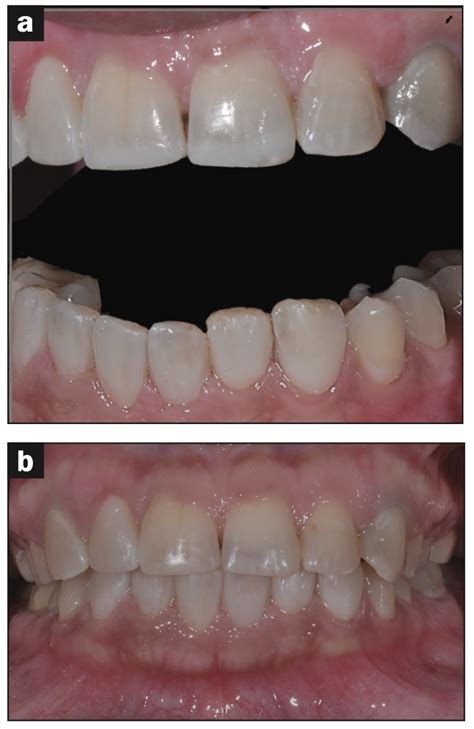 Use Of Minimally Invasive Techniques And Antimicrobial Agents To Treat