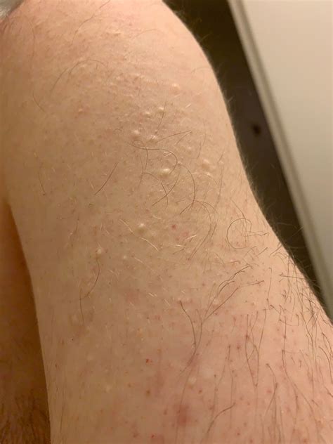 I Have White Bumps All Over My Upper Arms Shoulders And Back Not Sure