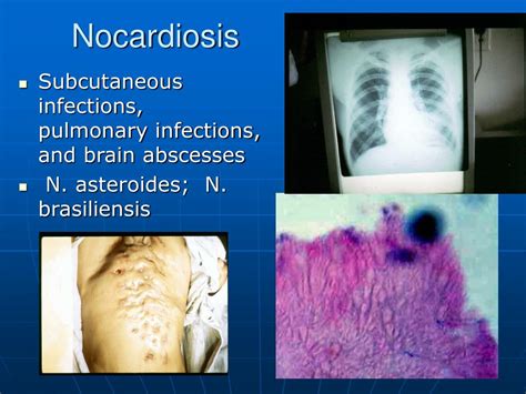 Ppt Actinomyces And Nocardia Powerpoint Presentation Free Download