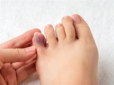 Four Common Misconceptions About Toe Fractures FootNetwork