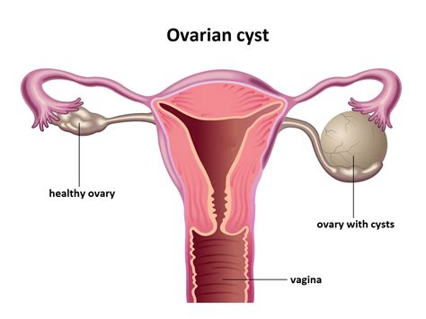 Laparoscopic Ovarian Cyst Removal Cystectomia Ovarii Medicover