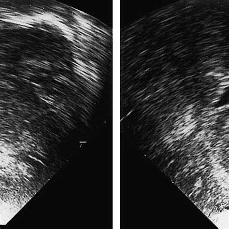 Case 2 Sequential Cranial Ultrasound Scans During The First Hours Of