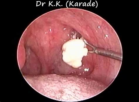Huge Tonsil Stones Removal In A Case Of Chronic Tonsillitis And Allergic