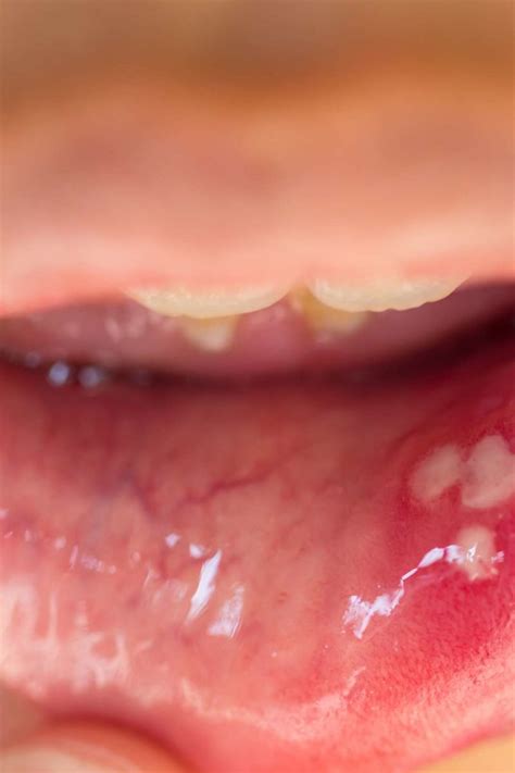 Hpv In The Mouth Symptoms Causes And Treatment