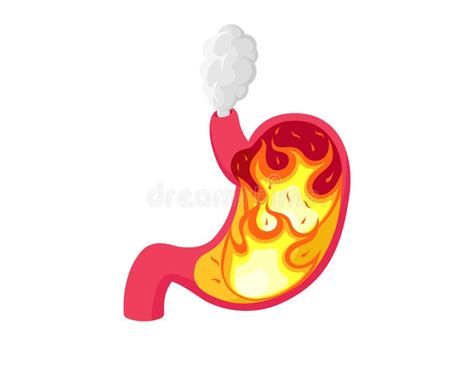 Stomach Heartburn With Burning Acid Inside Digestive System Gastritis