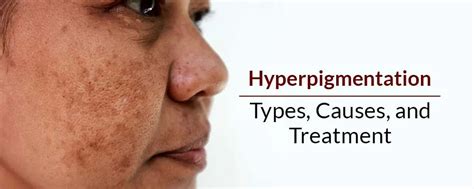 Hyperpigmentation Types Causes And Treatment Fixderma Skincare