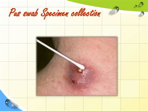 Ppt Pus Abscesses And Sinuses Wound And Burn Cultures Powerpoint