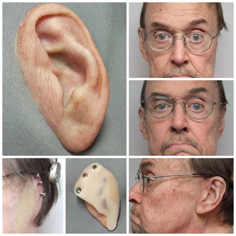 auricular photo gallery medical art prosthetics