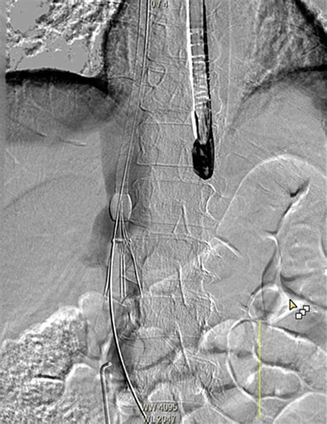 The Use Of Angiovac Thrombectomy In Ivc Filter Associated Ivc