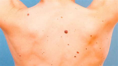 They are due to the development of abnormal cells that have the ability to invade or spread to other parts of the body. How to Tell if Moles Are Skin Cancer | Teen Vogue