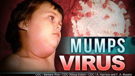 Us Mumps Cases At Highest Level In 10 Years