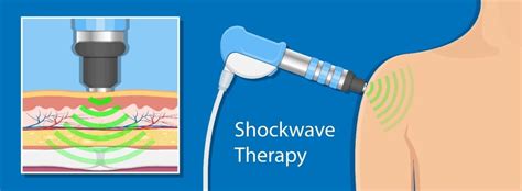 Shockwave Therapy For Calcifc Tendinopathytendinitis Complete Physio