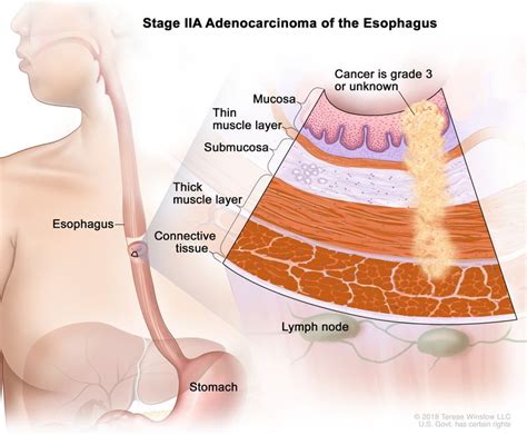 Esophageal Cancer Treatment Pdq Health Professional Version