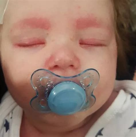 Meningitis Rash On Face From Meningitis To Eczema And Measles The