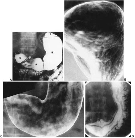 The Stomach And Duodenum Radiology Key