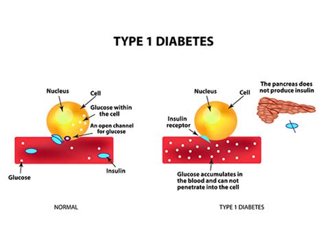 Type 1 Diabetes B Cell Derived Natural Antibodies Suppress Autoimmune