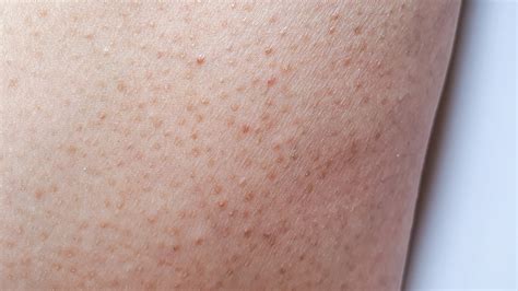 Heres Why You Have Little Bumps On Your Arms