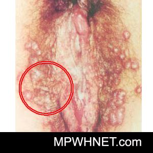 Herpes is separated into two types: Beginning Stages Of Herpes Pictures