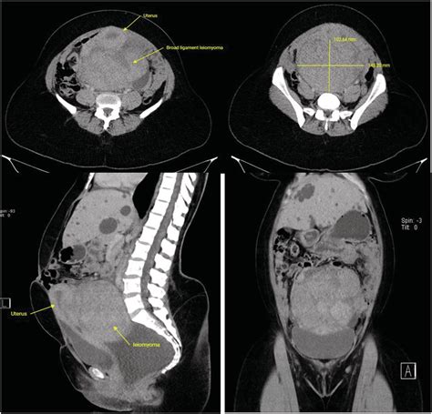 Ct Axial Sagittal And Coronal Images Of The Abdomen And Pelvis Show A
