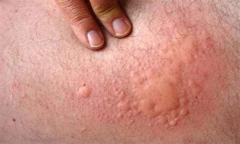 Stress Hives Causes Pictures And Treatments