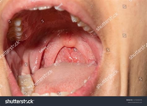 Sore Throat Throat Swollen Closeup Open Foto Stock 1272039379