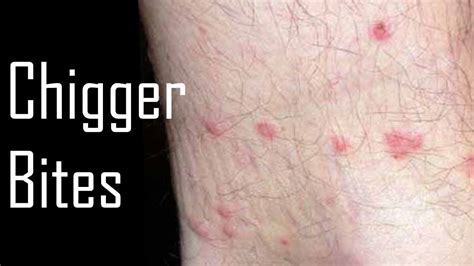 How To Get Rid Of Chigger Bites