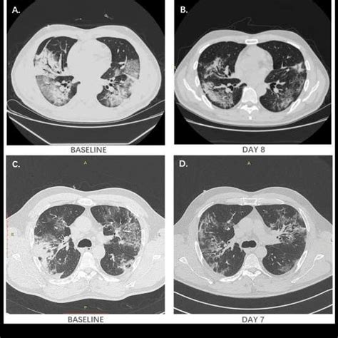 Representative Chest Ct Images A And B Typical Chest Ct Images Of A