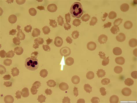 My Patient With Anemia Has An Abnormally High Mean Red Blood Cell