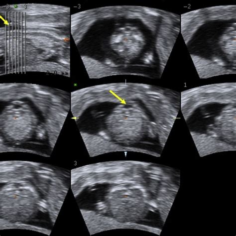 Tomographic Ultrasound Imaging Of The Brain Region The Yellow Arrows