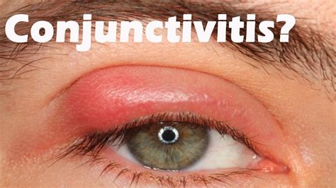Understanding The Three Kinds Of Conjunctivitis Causes And Symptoms