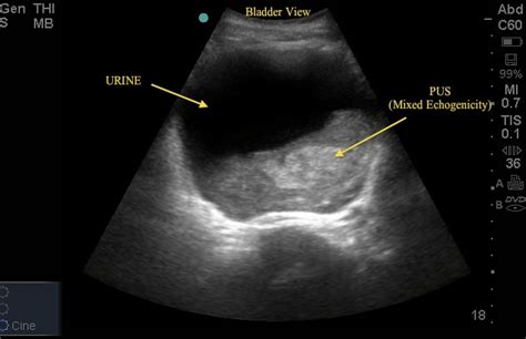 Urinary Retention Ultrasound Cases Info