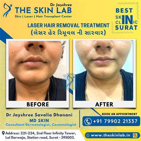 Top Laser Hair Removal Clinic In Surat With Affordable Cost The Skin Lab
