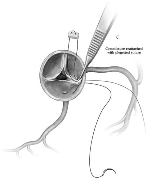 Surgical Unroofing For Anomalous Aortic Origin Of Coronary Arteries