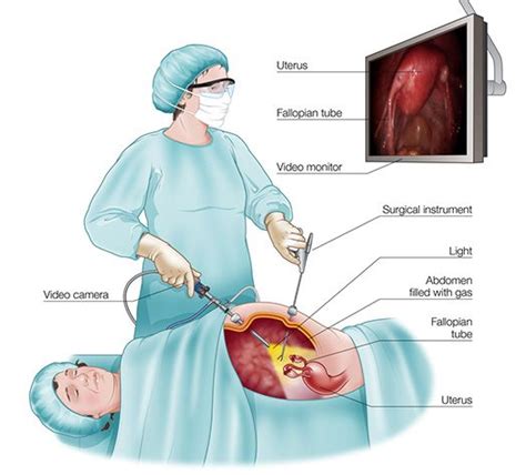 Women Medical Procedures Laparoscopy Hysterectomy Hysteroscopy
